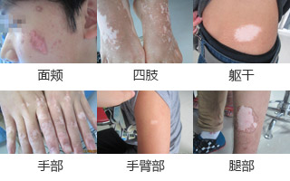 温州白癜风医院那家好